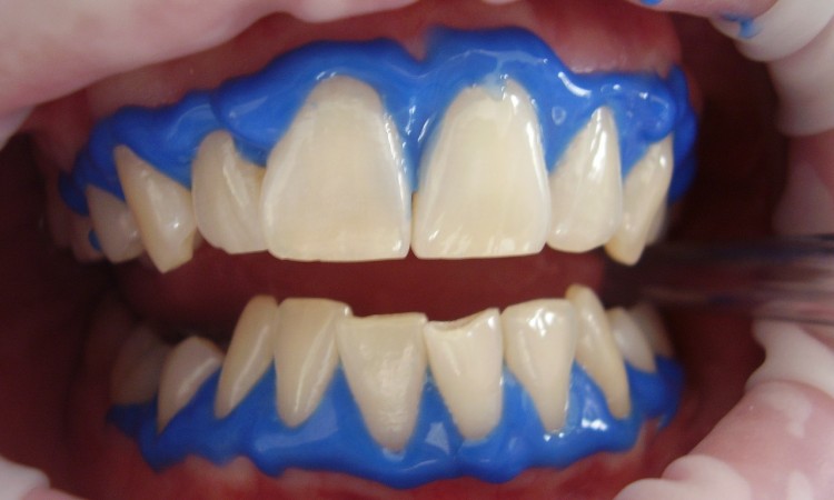 laser-teeth-whitening-716468_1280
