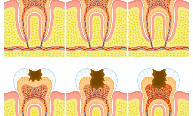 13078989 - internal structure of tooth: decay and caries